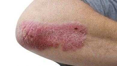 دراسة حديثة: الرجال أكثر عُرضة للإصابة بالحالات الشديدة من الصدفية!