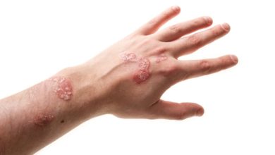 التهاب الجلد العصبي