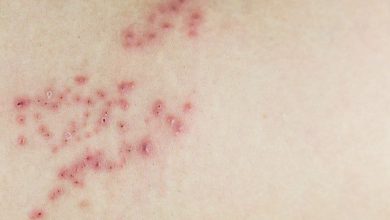 بقع حمراء على الجلد