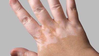 أكلات ممنوعة لمرضى البهاق