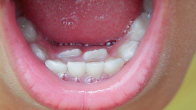 ظهور الأسنان الدائمة قبل سقوط اللبنية