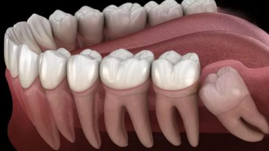 علاج تورم اللثة حول ضرس العقل