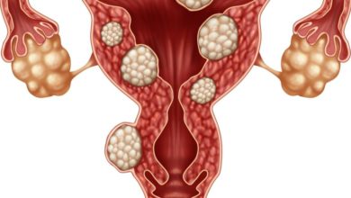 سرطان بطانة الرحم