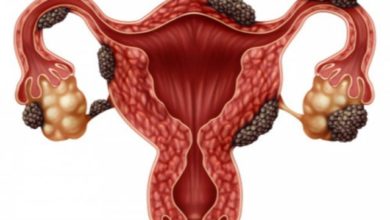 متلازمة المبيض المتعدد الكيسات