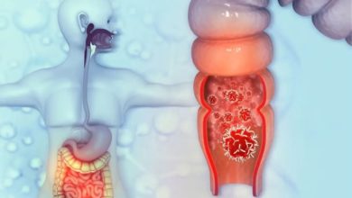 سرطان القولون والمستقيم